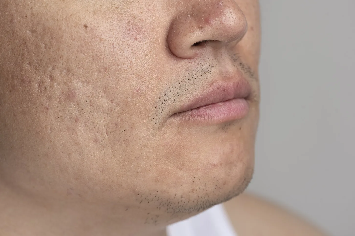medical dermatology woman acne scars on face