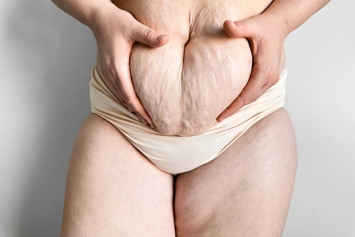 medical dermatology woman close-up-woman-with-stretch-marks