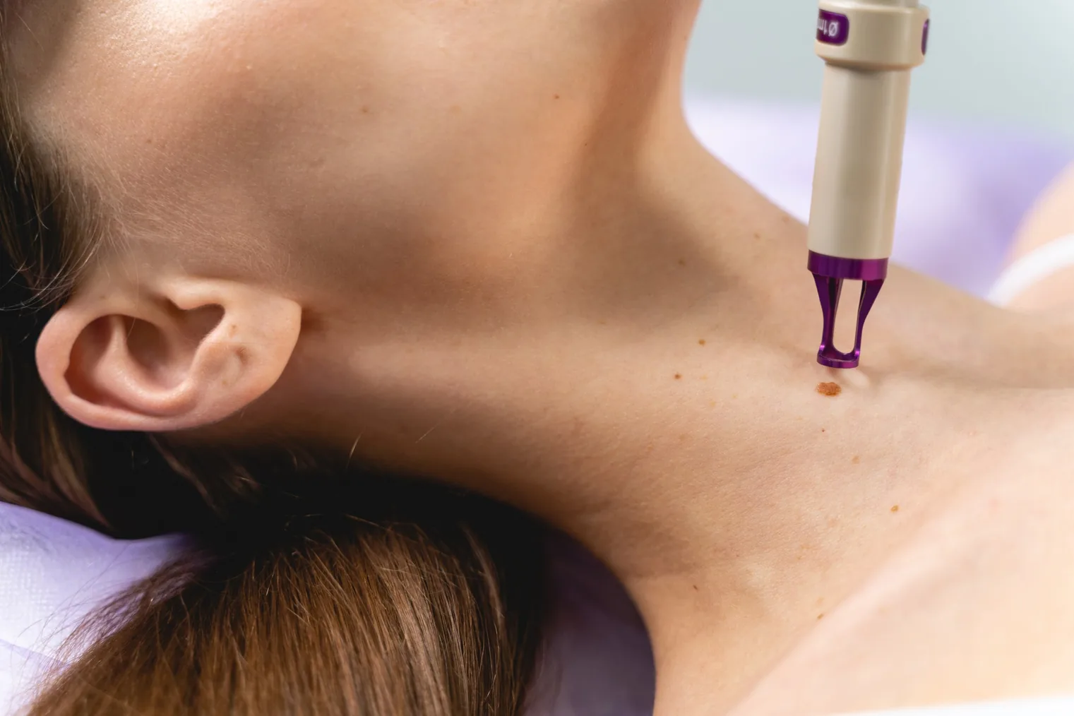 medical dermatology woman dermatologist-removing-mole-from-womans-shoulder (1)