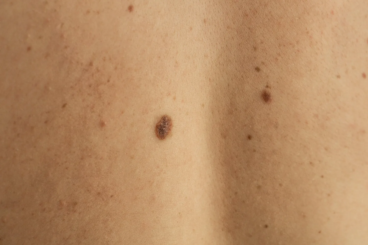 medical dermatology woman close-up-hand-with-different-size-moles