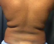 coolsculpting back after