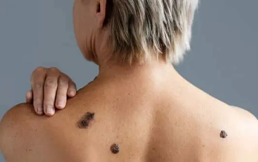 Back view woman with skin cancer