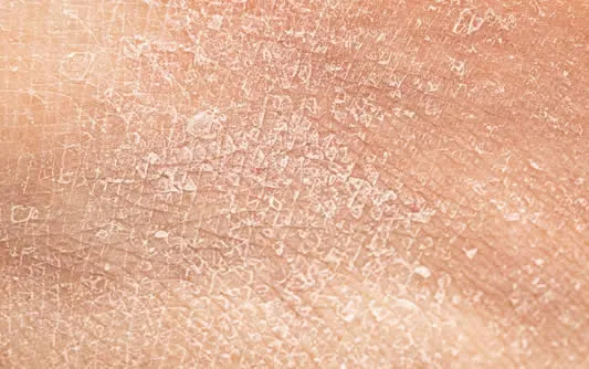 Dry human skin