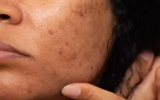 woman with acne